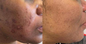 Acne treatment, Лечение угревой сыпи в клинике доктора Патласова